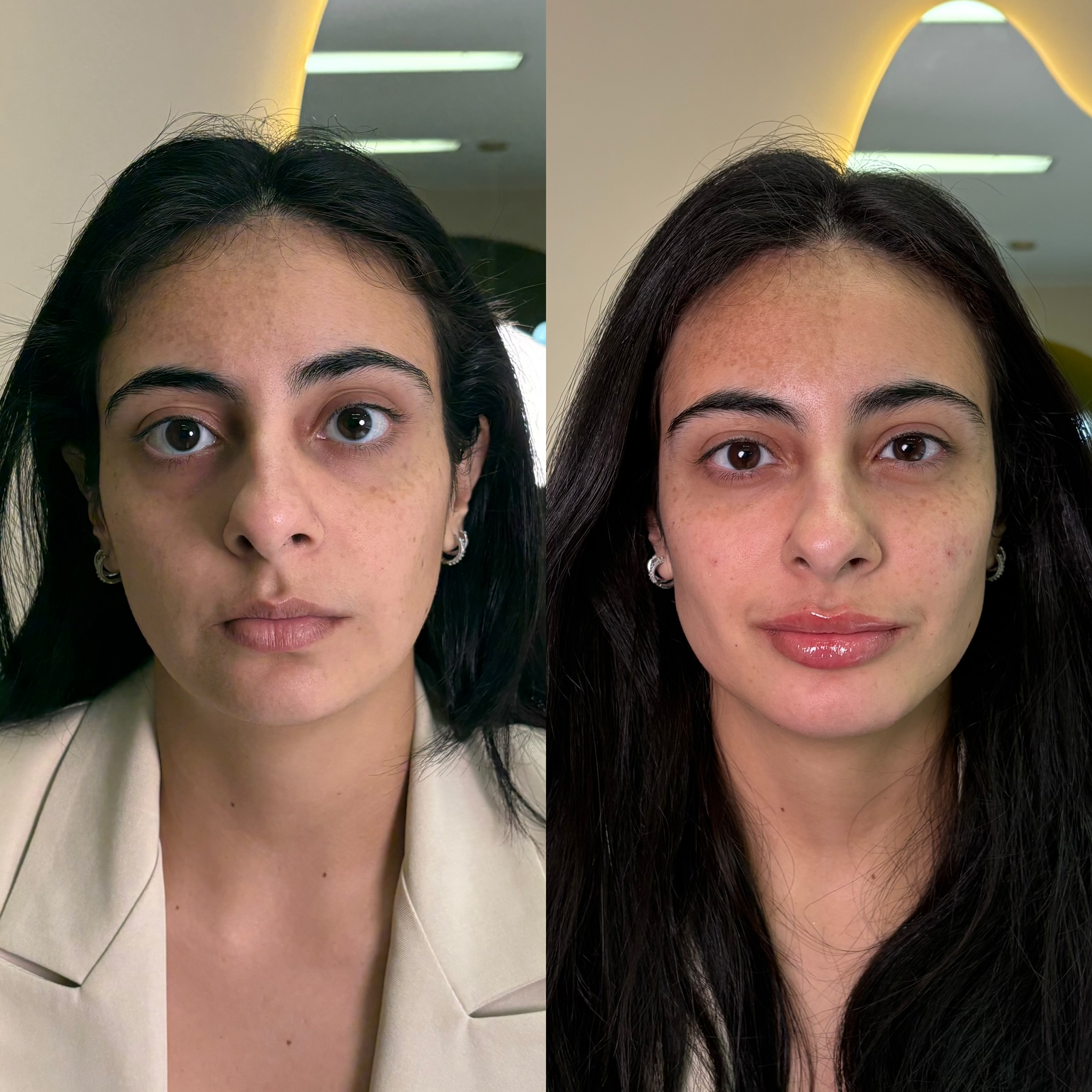 Harmonização full face — antes e depois caso 01